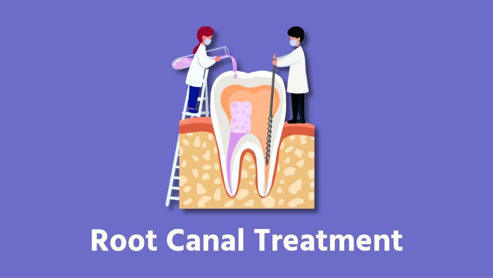 What is Root Canal Treatment